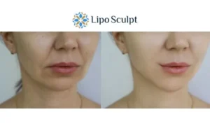 Explaining Total Skin Tightening Treatment And What It Can Do For You 2 Do you want to boost your self confidence? Give Morpheus8 Highworth a try today!