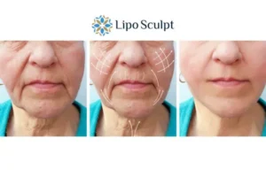 Explaining Total Skin Tightening Treatment And What It Can Do For You 3 Boost your confidence with Morpheus8 Highworth call our team today!