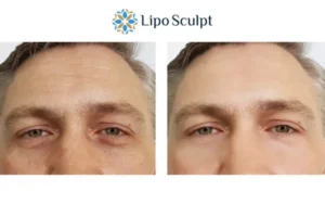 Explaining Total Skin Tightening Treatment And What It Can Do For You 6 Morpheus8 Highworth book in today to find out more!