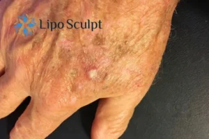 Best Actinic Keratoses Removal 2 Improve your wellbeing and health with Actinic Keratoses Highworth removal.treatment
